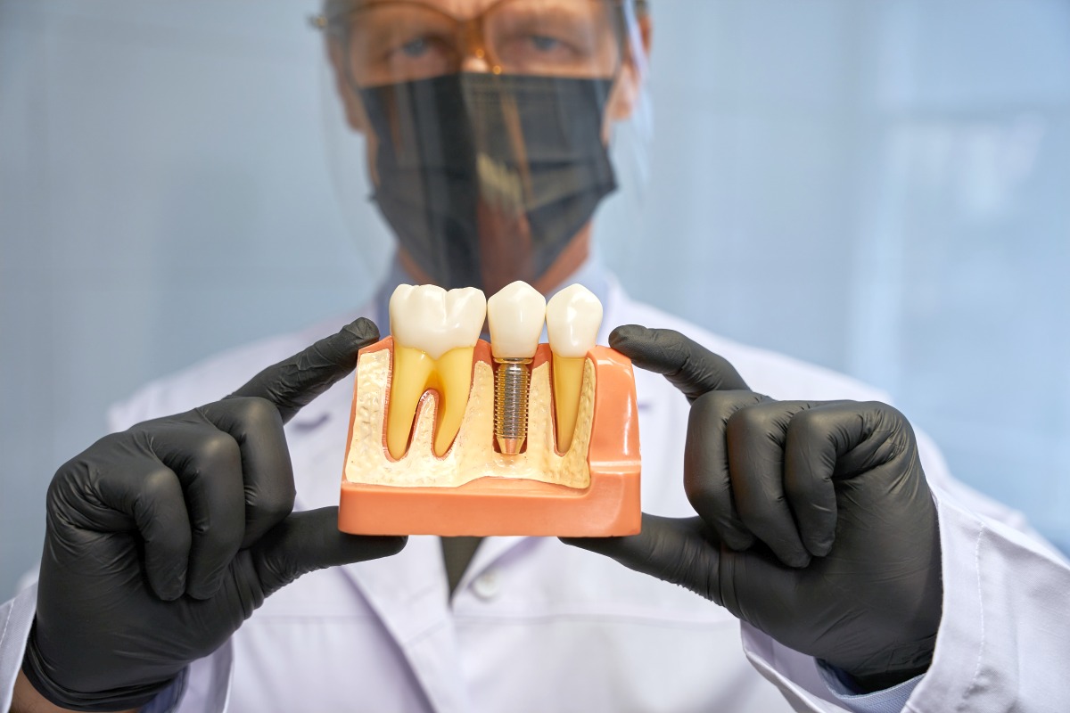 Jak długo wytrzymują implanty zębów